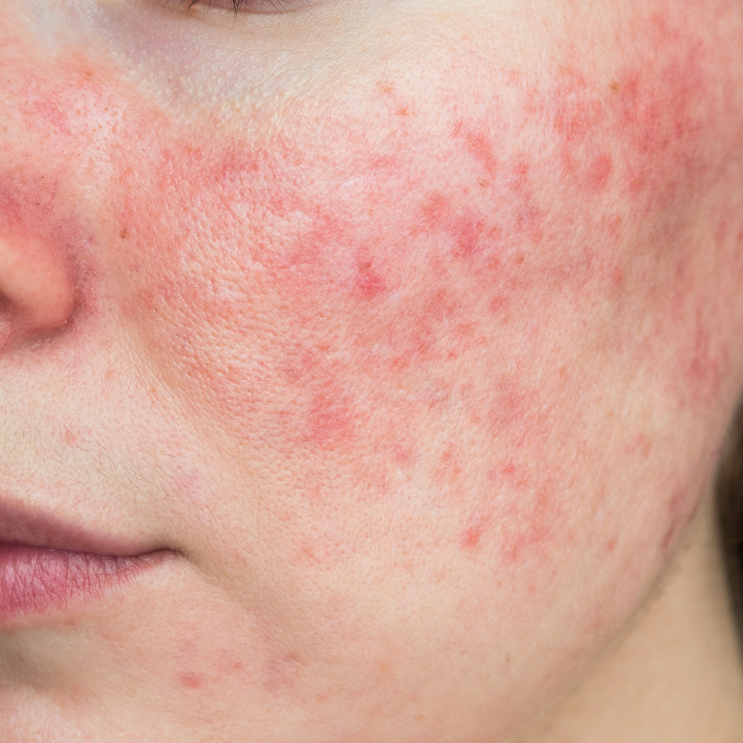 Rosacea Awareness Month: How to Calm, Protect & Support Your Skin