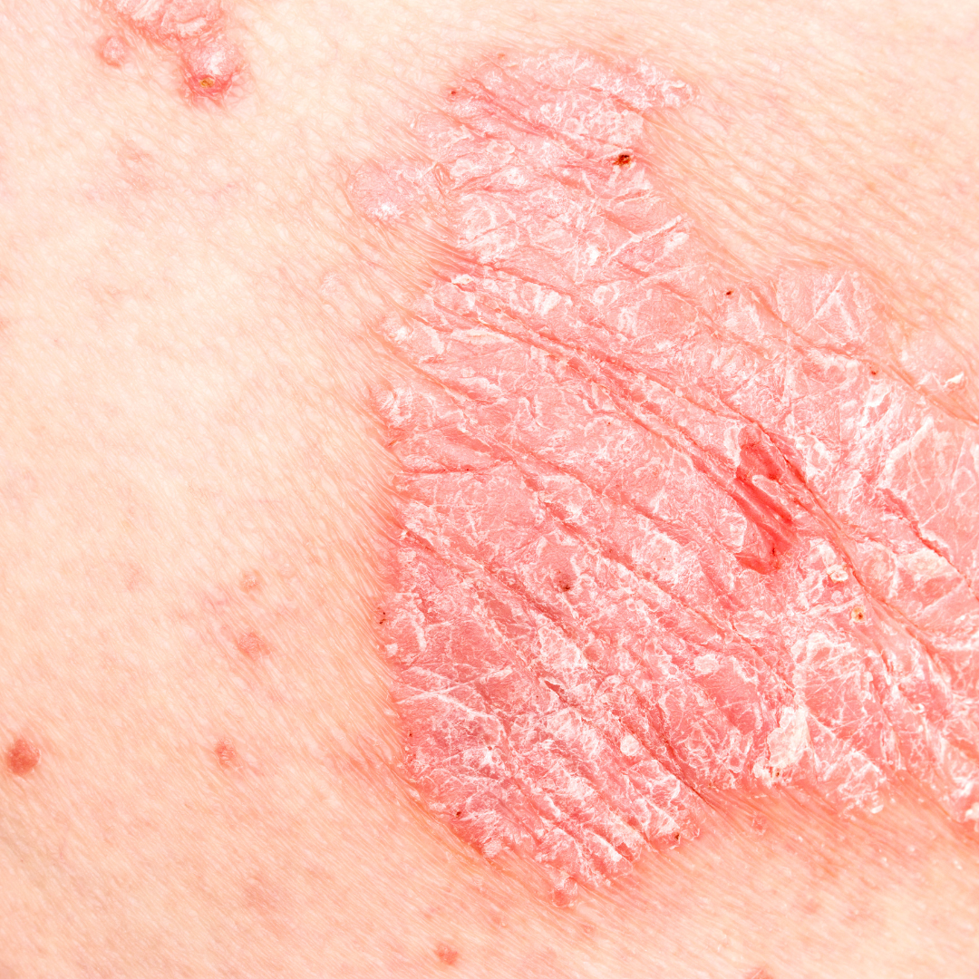 Psoriasis Awareness Month: Caring for Skin That Needs Extra Support