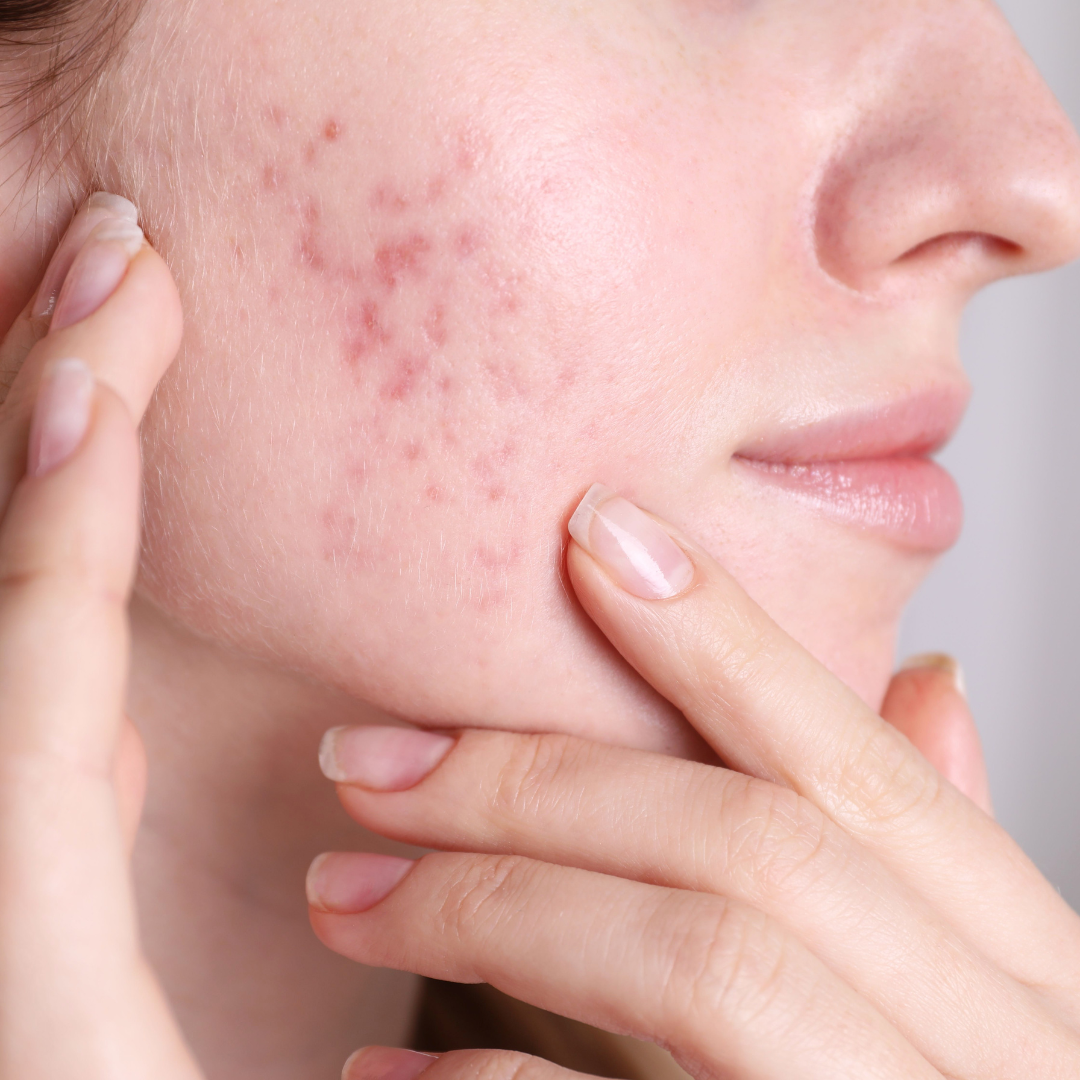 Understanding Acne Scars: Types & Effective Treatments