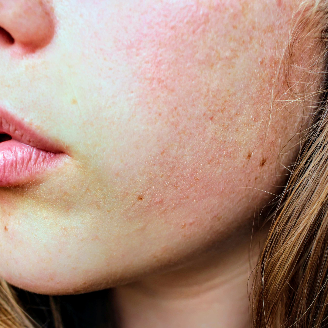 Eczema Awareness: How to Care for Dry, Sensitive & Compromised Skin